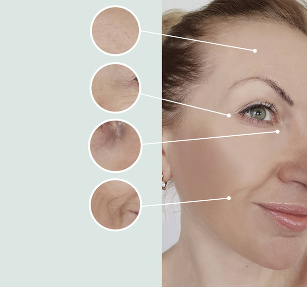 arrugas de mujer antes y después de los tratamientos
 - Foto, Imagen