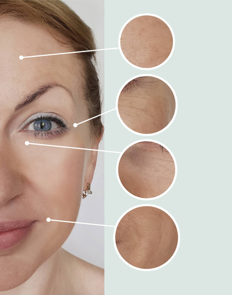 arrugas de mujer antes y después de los tratamientos
 - Foto, imagen