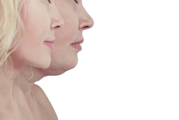 Frau mit Doppelkinn vor und nach Eingriffen - Foto, Bild