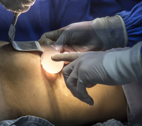 Silicone implantaat hechting patiënt - Foto, afbeelding