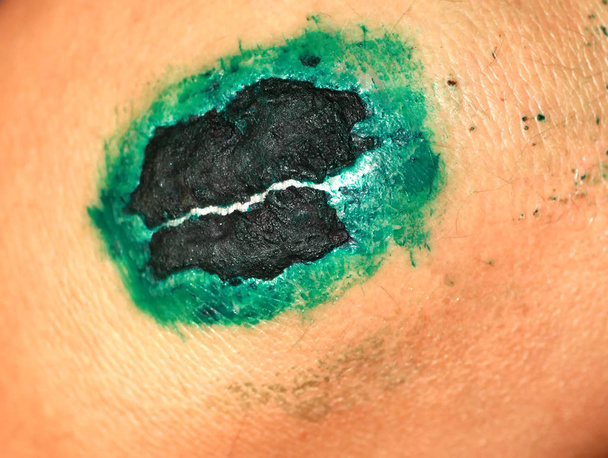 Healing wound on the knee. The wound treated with brilliant green. The scab will climb - Photo, Image
