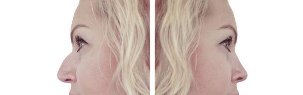 μύτη θηλυκό καμπούρα πριν και μετά από διαδικασίες - Φωτογραφία, εικόνα