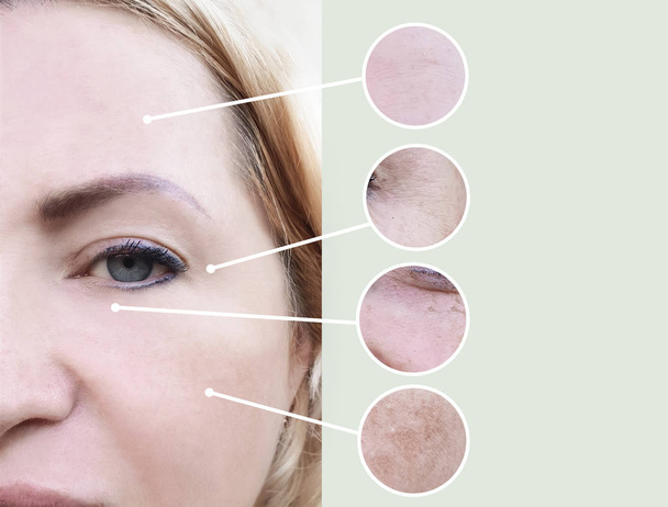 arrugas femeninas antes y después de los procedimientos
 - Foto, Imagen