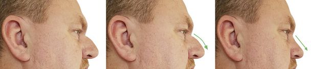 miesten nenäkyttyrä ennen ja jälkeen toimenpiteiden kollaasi
 - Valokuva, kuva