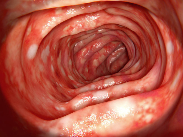 3d ilustración por ordenador de un colon humano afectado por la colitis ulcerosa. La colitis ulcerosa es una enfermedad inflamatoria del intestino humano.
.  - Foto, Imagen