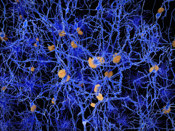 Alzheimer disease, neuron network with amyloid plaques. Illustration - Photo, Image