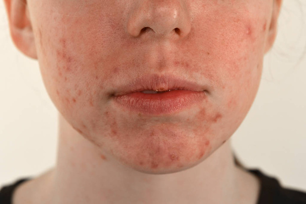 μετά-ακμή, ουλές και κόκκινα σπυράκια στο πρόσωπο μιας νεαρής γυναίκας. έννοια των δερματικών προβλημάτων και της αρμονικής αποτυχίας - Φωτογραφία, εικόνα