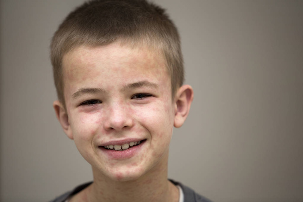 Portré beteg mosolygó fiú gyermek szenved, kanyaró, vagy Chi - Fotó, kép