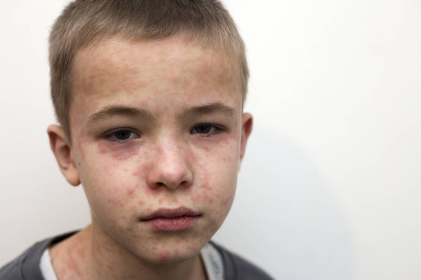 Portré beteg szomorú fiú gyermek szenved, kanyaró vagy csirke - Fotó, kép