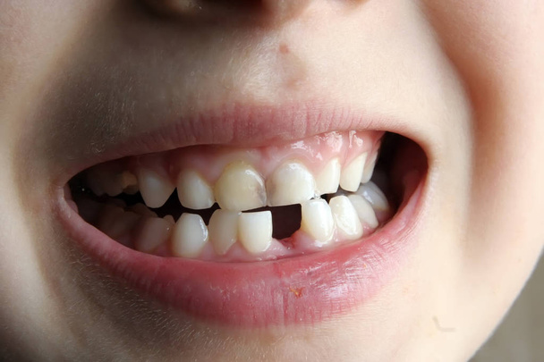 Kind ontbrekende tand. Kid ontbreekt een tand. Kloof tussen kinderen tanden. - Foto, afbeelding
