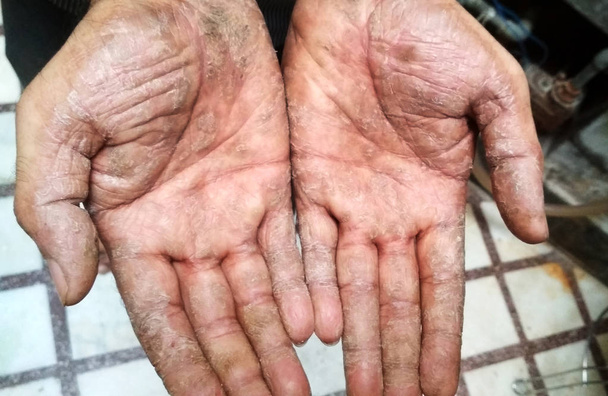 男性の手に乾癬疾患。男性の手の内側に硬い、割れた皮膚。手のひらにひび割れた、フレーク状の皮膚。乾癬の皮膚科学的問題. - 写真・画像