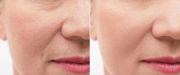 Mature woman before and after biorevitalization procedure, closeup. Cosmetic surgery - Photo, Image