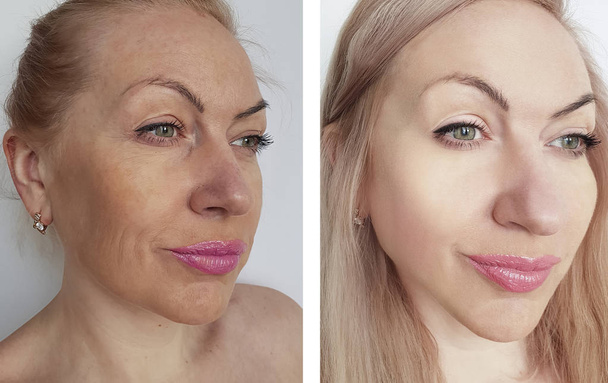 arrugas femeninas antes y después de los procedimientos de corrección
 - Foto, Imagen