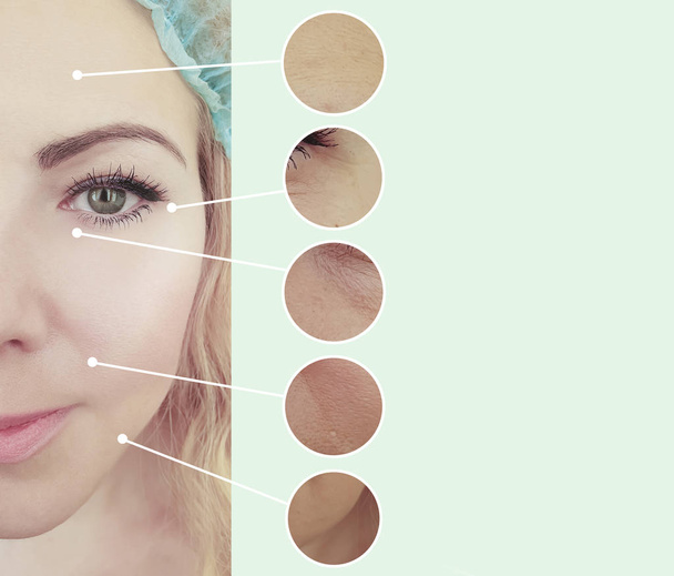 arrugas de la mujer antes y después de los procedimientos de corrección, collage
 - Foto, Imagen