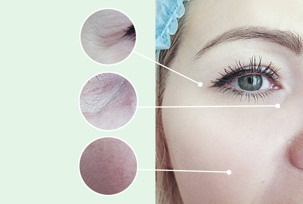 arrugas de la mujer antes y después de los procedimientos de corrección, collage
 - Foto, Imagen