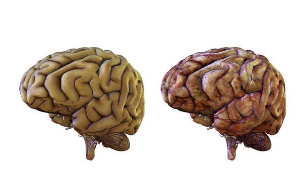 menschliches Gehirn im Vergleich gesund und entzündet, geschädigt - Foto, Bild