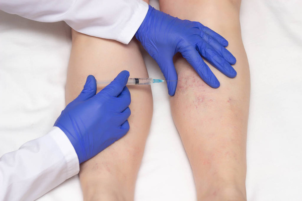 Doctor in medical gloves injects sclerotherapy procedure on the legs of a woman against varicose veins, close-up, ozone therapy, medical - Fotografie, Obrázek