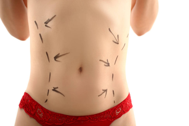 Female body with markup before liposuction - Foto, Imagen