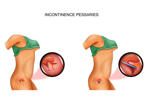 use of pessary for incontinence - Vector, Image