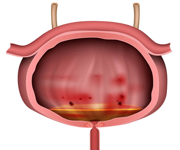 Воспаление мочевого пузыря 3d векторная иллюстрация без этикетки на белом фоне
 - Вектор,изображение