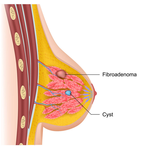 Mell ciszták és Fibroadenoma orvosi vektor illusztráció - Vektor, kép