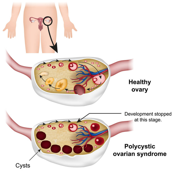 Polycystische ovarium syndroom medische vector illustratie - Vector, afbeelding