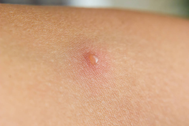 primer plano de varicela en la piel
 - Foto, Imagen