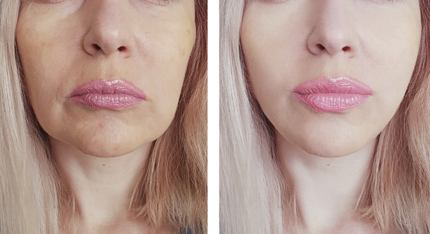 arrugas de la mujer antes y después de procedimientos
 - Foto, imagen
