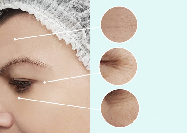arrugas de la mujer antes y después de los procedimientos, collage
 - Foto, Imagen