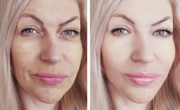γυναίκα ρυτίδες πριν και μετά από διαδικασίες - Φωτογραφία, εικόνα