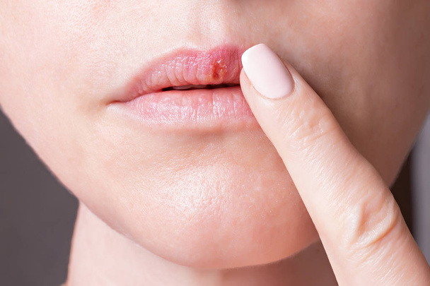 part of a womans face , herpes on the lips, beauty concept - 写真・画像