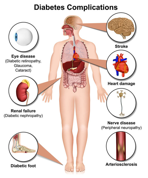 Diabetes complicações e doenças médica 3d vetor ilustração no fundo branco
 - Vetor, Imagem