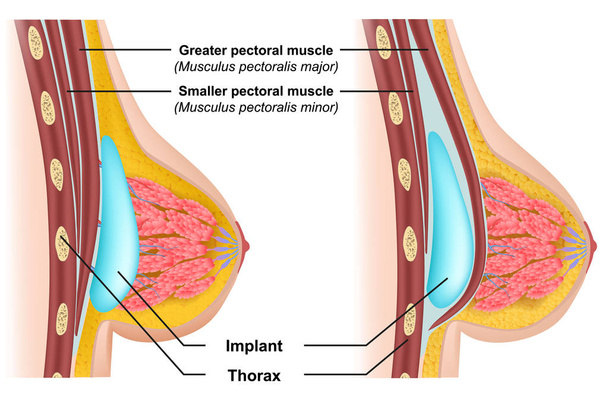 Illustration vectorielle médicale d'insertion d'implant mammaire
 - Vecteur, image