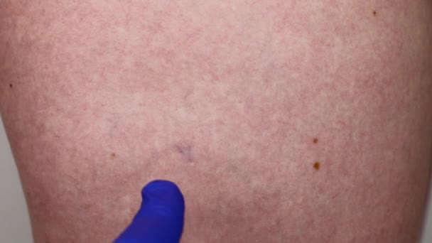 Τριχοειδές πλέγμα στο πόδι του κοριτσιού. Ο γιατρός στα γάντια μπλε σιλικόνης εξετάζει η ζημιά στα τριχοειδή αγγεία - Πλάνα, βίντεο