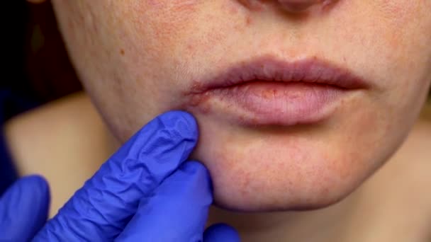 Herpes en los labios: una mujer con un resfriado y el virus del herpes es examinado por un dermatólogo y especialista en enfermedades infecciosas
 - Imágenes, Vídeo