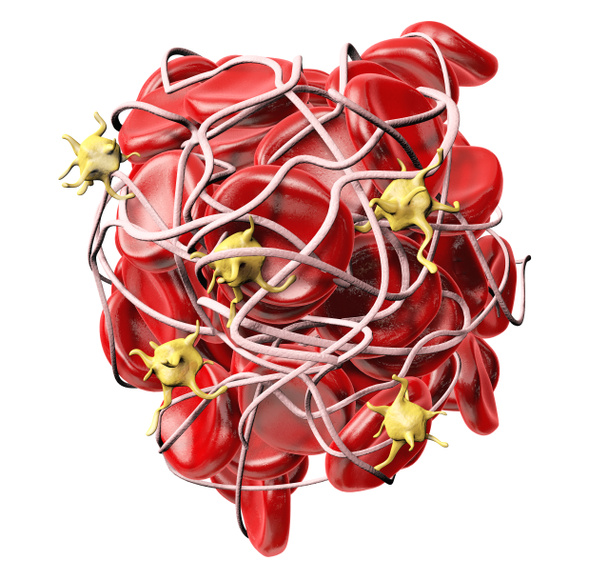 Trombo, coágulo sanguíneo con plaquetas activadas y fibrina, ilustración médicamente 3D
 - Foto, imagen