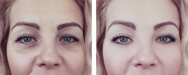 zmarszczki kobieta przed i po procedur kolaż - Zdjęcie, obraz