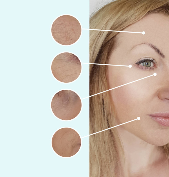 arrugas de la mujer antes y después de los procedimientos collage
 - Foto, Imagen