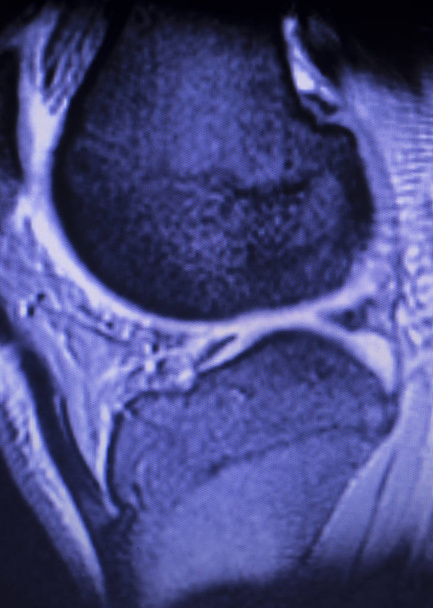 MRI knie meniscus traan scan - Foto, afbeelding