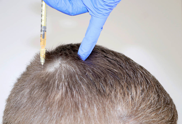 Mezoterapia włosów lub przeszczep włosów: kosmetyczka lekarz robi zastrzyki w mans głowy dla wzrostu włosów lub zapobiec Łysienie - Zdjęcie, obraz