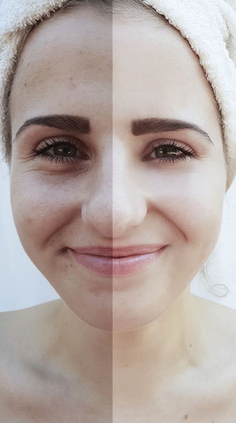 rugas oculares femininas antes e depois de procedimentos de elevação
 - Foto, Imagem