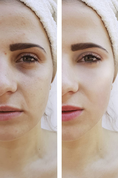weibliche Augenfalten vor und nach dem Lifting - Foto, Bild