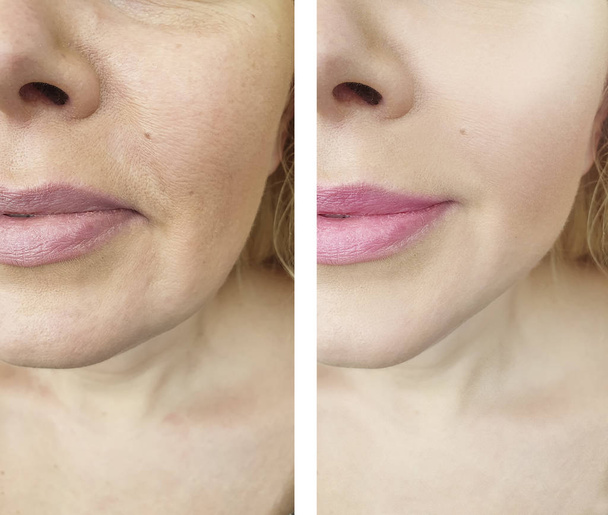 arrugas de la mujer antes y después del procedimiento
 - Foto, Imagen
