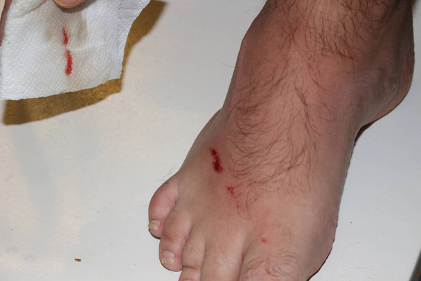Поранена нога з кровоточивим стиранням, ізольована на білому тлі
. - Фото, зображення