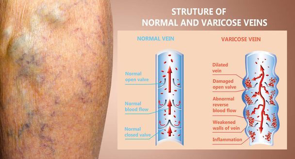 Venas varicosas en las piernas de una mujer mayor. La estructura de las venas normales y varicosas. - Foto, Imagen