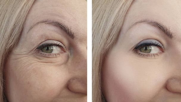 жіночі зморшки очей до і після процедур
 - Фото, зображення