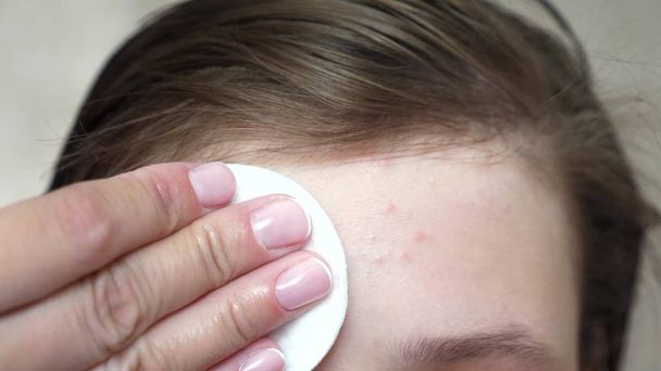 Teenagerky používají pro Acne zvlhčující krém. dívka se ubrouskem na čelo. Kosmetické postupy pro mladistvé. Close-up - Fotografie, Obrázek