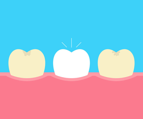Před a po bělení koncept péče o ústní dutinu na žlutém pozadí. Vektorové ilustrace - Vektor, obrázek