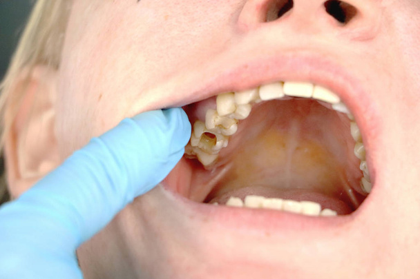 Η τρύπα στο δόντι και τη θεραπεία των οδοντιατρικών κανάλια. Θεραπεία της περιοδοντίτιδας στην οδοντιατρική κλινική - Φωτογραφία, εικόνα