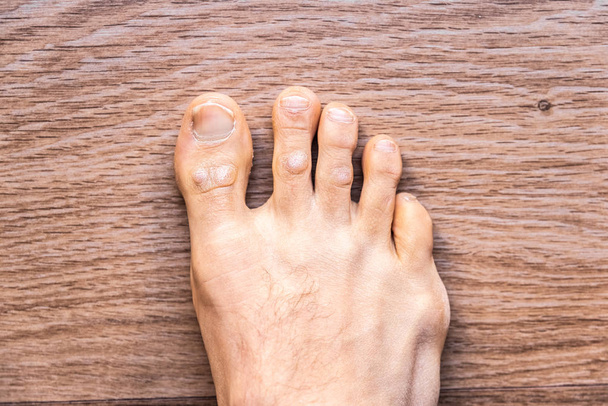 Piedi di uomo scalzo con dermatite da psoriasi sulle dita
. - Foto, immagini